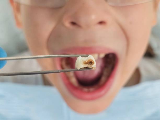 Best Emergency Dental Filling Replacement  in Ocean Acres, NJ